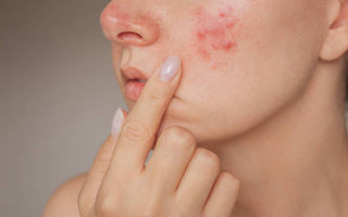 Red Light Therapy for Acne & Skin Inflammation: A Gentle Path to Clearer Skin