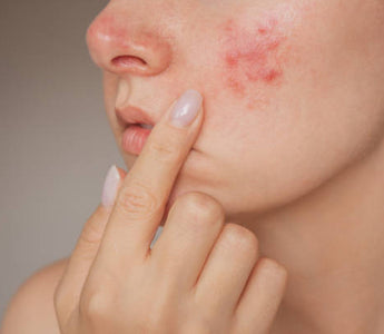 Red Light Therapy for Acne & Skin Inflammation: A Gentle Path to Clearer Skin