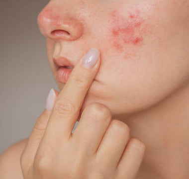 Red Light Therapy for Acne & Skin Inflammation: A Gentle Path to Clearer Skin