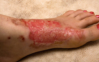 Red Light Therapy for Burn Recovery: Soothing Inflammation and Speeding Healing
