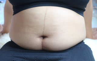 Laser Therapy for C-Section Recovery: Scar Healing and Abdominal Pain Relief