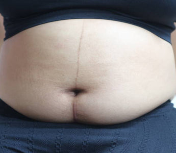 Laser Therapy for C-Section Recovery: Scar Healing and Abdominal Pain Relief