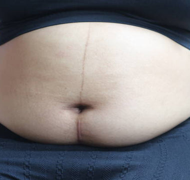 Laser Therapy for C-Section Recovery: Scar Healing and Abdominal Pain Relief
