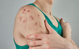 Laser Therapy for Psoriasis & Eczema: Can It Help Skin Conditions?