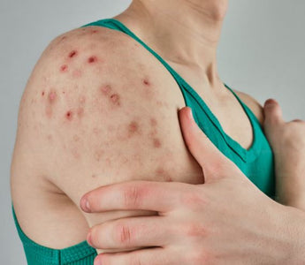 Laser Therapy for Psoriasis & Eczema: Can It Help Skin Conditions?