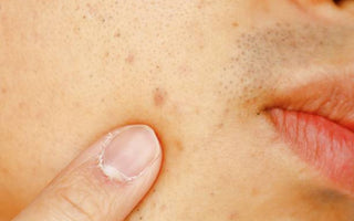 Cold Laser Therapy for Post-Inflammatory Hyperpigmentation (PIH)