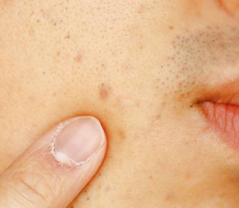 Cold Laser Therapy for Post-Inflammatory Hyperpigmentation (PIH)