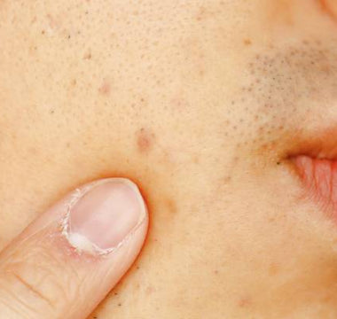 Cold Laser Therapy for Post-Inflammatory Hyperpigmentation (PIH)
