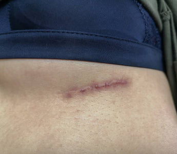 Cold Laser Therapy for Post-Mastectomy Scar Healing and Pain Relief