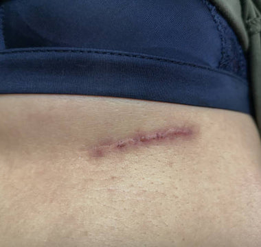 Cold Laser Therapy for Post-Mastectomy Scar Healing and Pain Relief