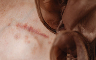 Cold Laser Therapy for Post-Surgical Scar Management: Enhancing Cosmetic and Functional Healing