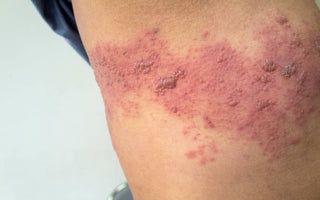 Laser Therapy for Post-Herpetic Neuralgia: Managing Nerve Pain After Shingles