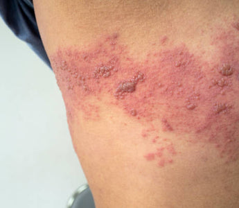 Laser Therapy for Post-Herpetic Neuralgia: Managing Nerve Pain After Shingles