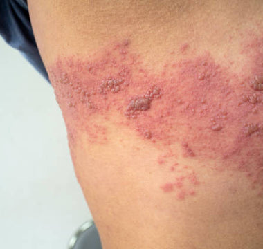 Laser Therapy for Post-Herpetic Neuralgia: Managing Nerve Pain After Shingles