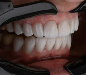 Can Laser Therapy Help with Bruxism and Teeth Grinding?