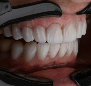 Can Laser Therapy Help with Bruxism and Teeth Grinding?