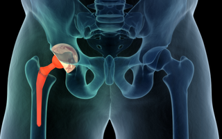 Photobiomodulation therapy used in a clinical trial during the recovery of hip arthroplasty surgery