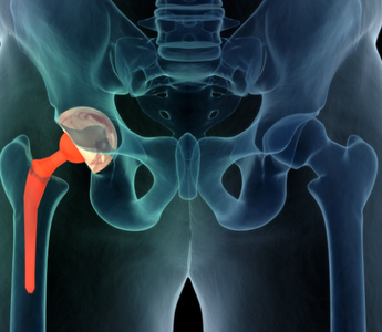 Photobiomodulation therapy used in a clinical trial during the recovery of hip arthroplasty surgery