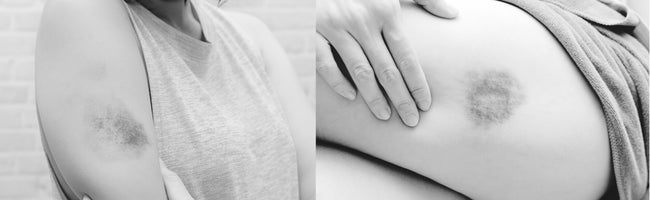 Bruises and hematoma treatment diagram showing laser therapy application